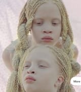 Albino African girls