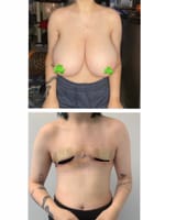 breast-reduction-war-crime