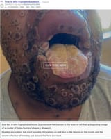 monkeypox plus the HIV tongue face
