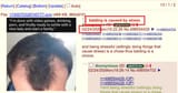 balding 21