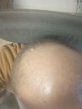 bald head