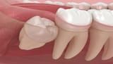 wisdom-teeth