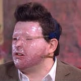 acidattack