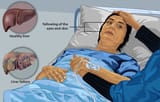 1920px-Depiction_of_a_liver_failure_patient