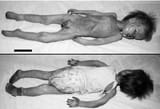Overall-state-of-childs-body-Black-bar-10-cm-Courtesy-of-the-Institute-of-Legal