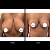 RPS_BeforeAfter_BreastReduction_01-03