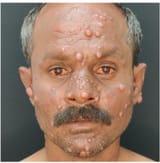 Leprosy
