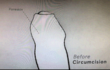 circumcision
