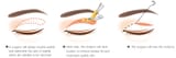 image007 - Diagram showing how a surgeon will design double eyelids and determine the size of eyelids