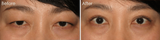 Double-Eyelid-Surgery-Before-and-After-1-1 - Close-up of a womans eyes before and after cosmetic surgery