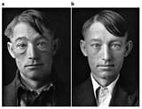 Photo-of-a-36-year-old-man-before-a-and-41-days-after-start-of-therapy-with-thyroid