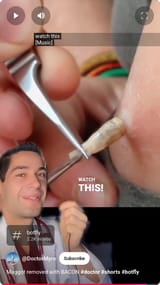 Screenshot 2025-07-11 at 14-18-12 (29) Maggot removed with BACON #doctor #shorts #botfly - YouTube