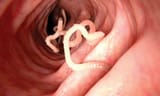image-of-tapeworms-in-digestive-tract