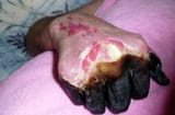 2-dry-gangrene-caused-by-the-plague-cdc