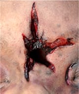forensicsgunshotwoundsgitto01