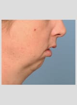 Severe-Chin-and-Jaw-Deficiency-Dr-Barry-Eppley-Indianapolis