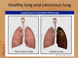 non-smokers-lungs_smokers-lungs