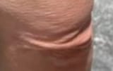 vulva elbow