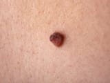 skin-mole-1785400087