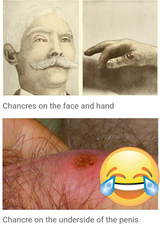 chancre