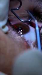lasik_1_thumb.jpg