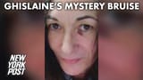 ghislaine_mystery_bruise