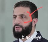 eye