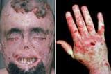 Victim Of Porphyria(1)(1)
