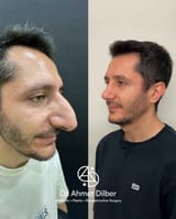 jew nose plastic surgery