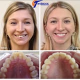 6188452d073a2f75e38d9bc8_mild crowding and facial change due to arch form expansion