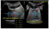 Ultrasound-heart