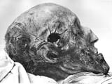charlesxiiautopsy1916