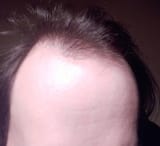 balding hairline norwood