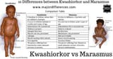 Kwashiorkor vs Marasmus