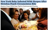 mezizah herpes