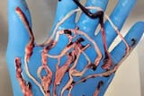 clot