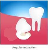 impactedteeth