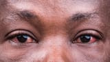 eyes-section-face-showing-infectious-600nw-2385638473