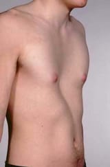 pectus-excavatum-Chest-wall-deformities