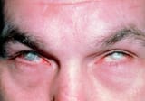 ammonia-burns-to-a-mans-eyes-western-ophthalmic-hospitalscience-photo-library