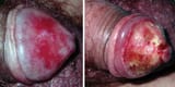 phimosis