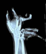 x-ray