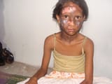 Girl_sufferedwithburnwounds