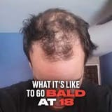 18 and going bald