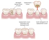 dental-crown-procedure-illustration-c33196
