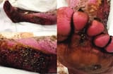 Myiasis Lower Limb Infection