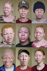 albinos2