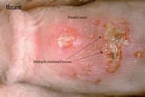 herpes-sores