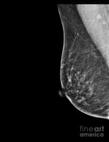 7-normal-mammogram-samunellascience-photo-library