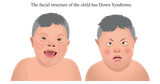 Down_Syndrome_72e0ee83f0